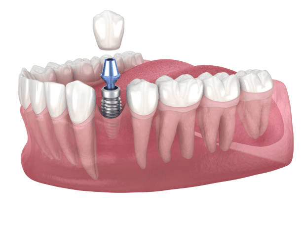 Traditional dental implants