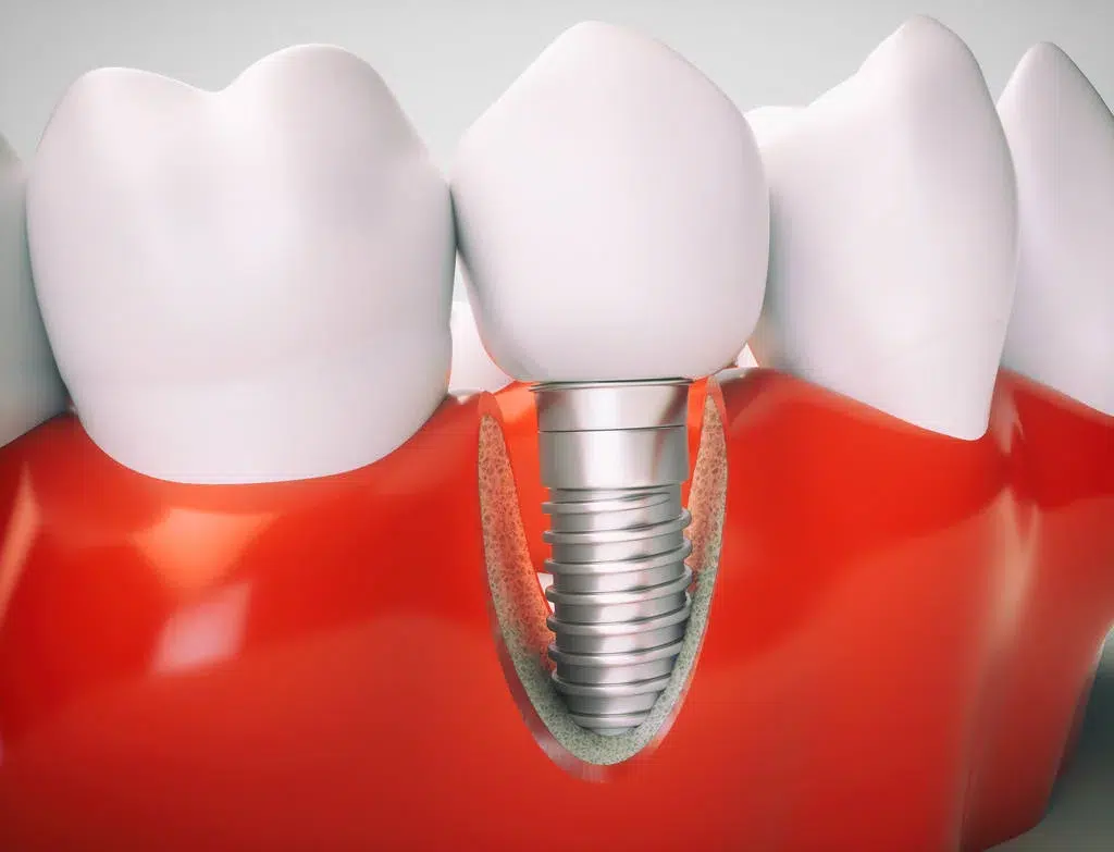Dentures And Implants