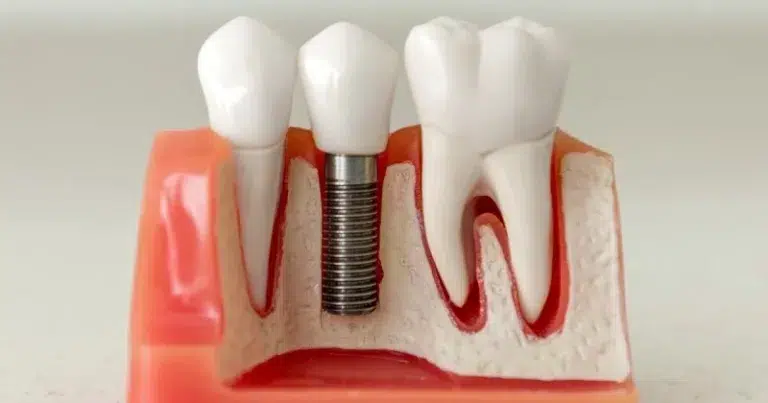 single-tooth-implants