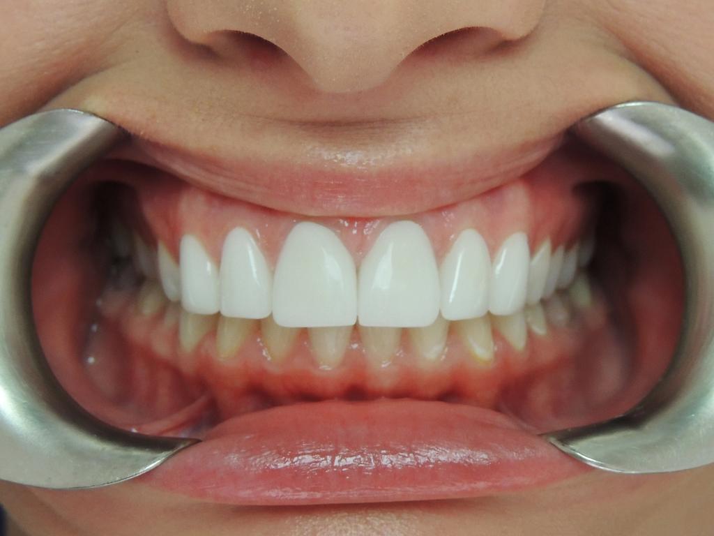 Can Receding Gums Grow Back